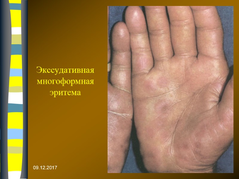 09.12.2017 Экссудативная многоформная эритема